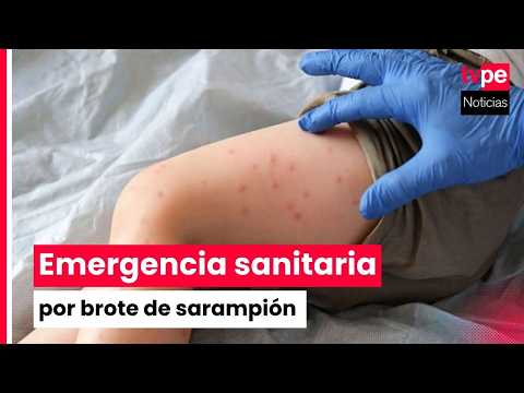 Emergencia sanitaria de 90 días por brote de sarampión